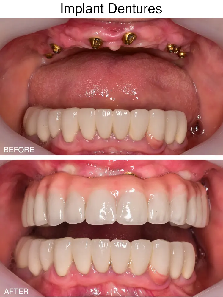 implant-dentures02