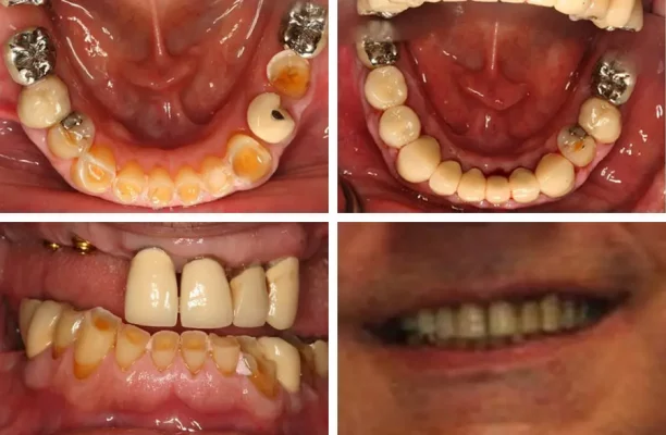 FULL MOUTH IMPLANTS, SINUS LIFTS, DENTURES, 11 CROWNS
