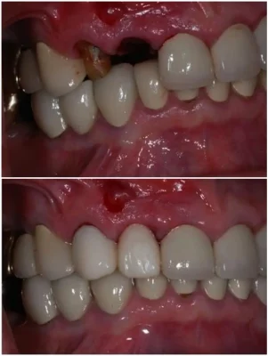 IMPLANT, 2 CROWNS
