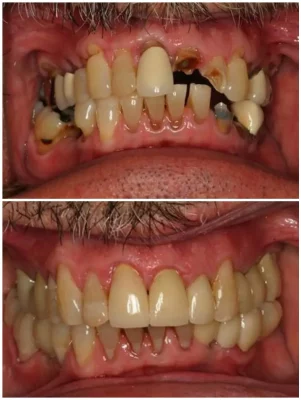 SMILE MAKEOVER, IMPLANTS, SINUS LIFT, 15 CROWNS