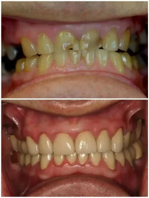 FULL MOUTH SINUS LIFT, IMPLANTS, 28 CROWNS