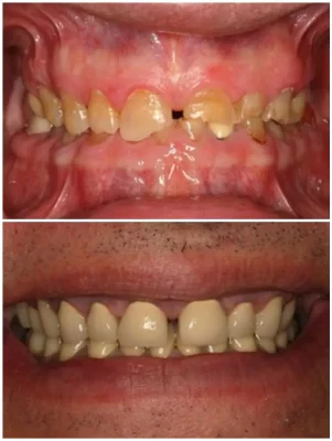 Full Mouth IMPLANTS, SINUS LIFT, 24 CROWNS